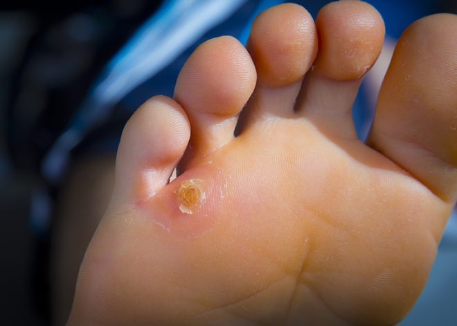 Understanding and Tackling Foot Corns: A Simple Guide